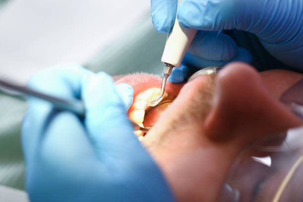 Best Emergency Dental Extractions in Orchard City, CO