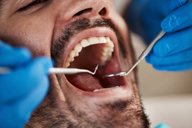 Best Emergency Dentist for Lost Fillings or Crowns in Orchard City, CO